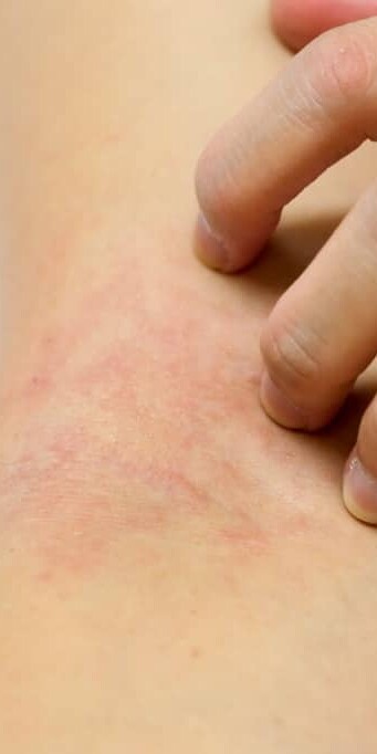 The signs of an allergic reaction can vary from person to person and depends on the type of insect bite or sting.