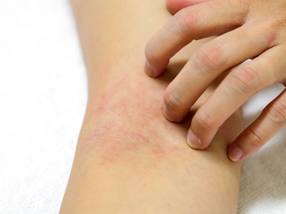The signs of an allergic reaction can vary from person to person and depends on the type of insect bite or sting.